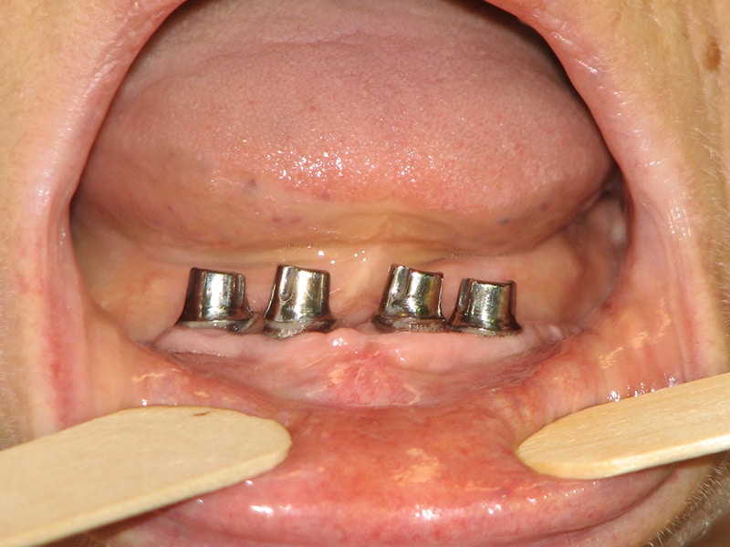 Implantatrehabilitation, Zahnimplantate, Prothesen