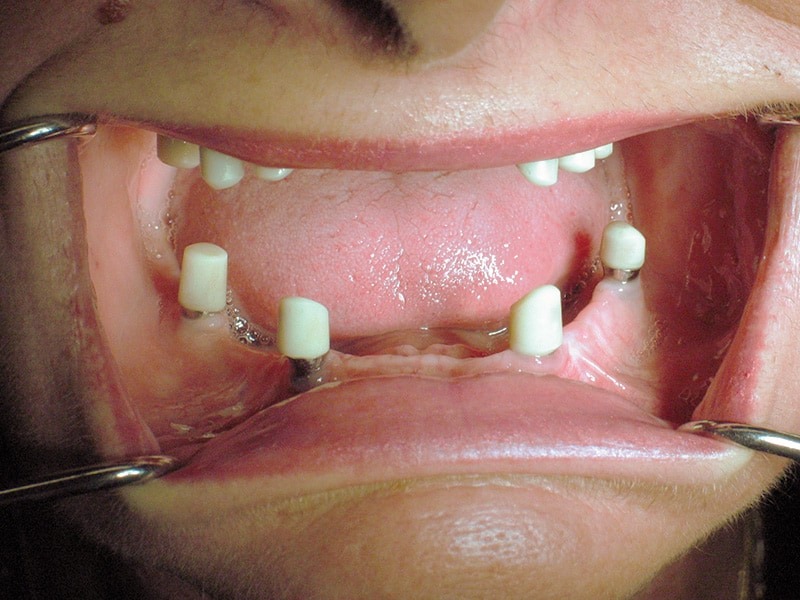 Implantatrehabilitation, Zahnimplantate, Prothesen