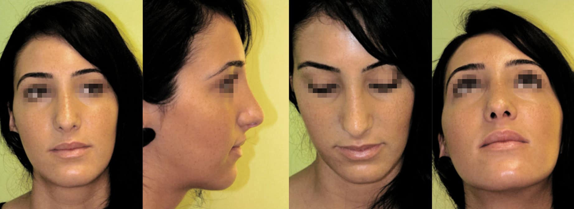 Rhinoplastik, Ästhetische Nasenkorrekturen, Spaltnasenkorrekturen