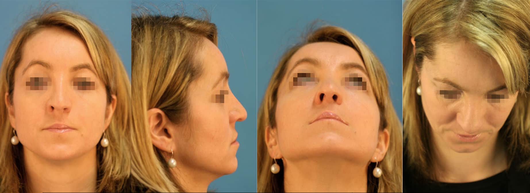 Rhinoplastik, Ästhetische Nasenkorrekturen, Spaltnasenkorrekturen