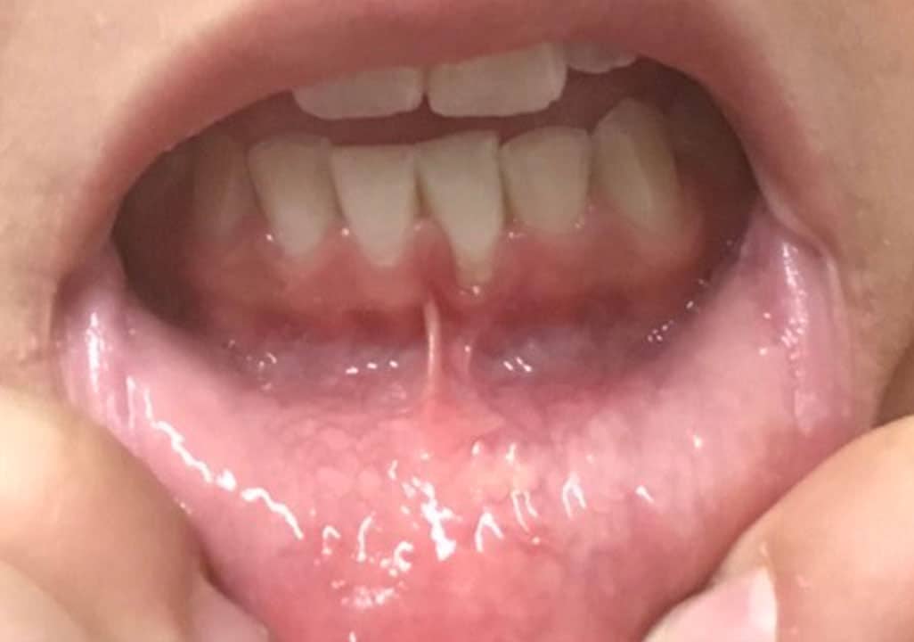 Gingivarezession, Zahnfleischrückgang, Parodontitis, Zahnfleischverletzung