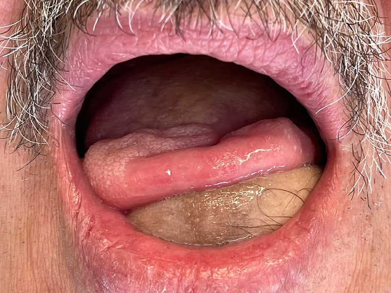 Intraoraler Tumor an der Zunge, Tumorchirurgie