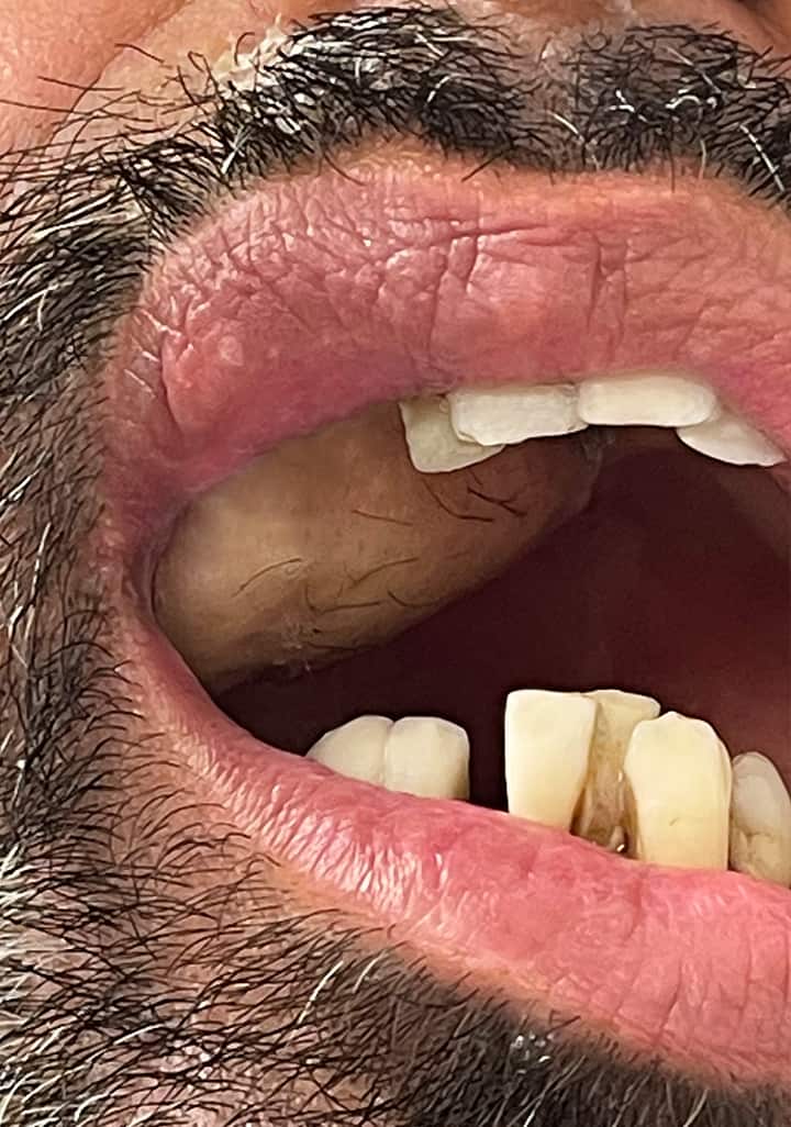 Intraoraler Tumor an der Zunge, Tumorchirurgie