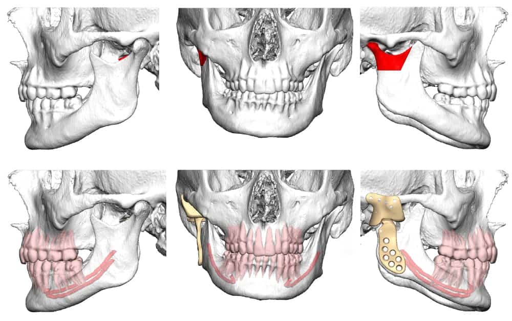 Diseases of the temporomandibular joint - Landes & Kollegen